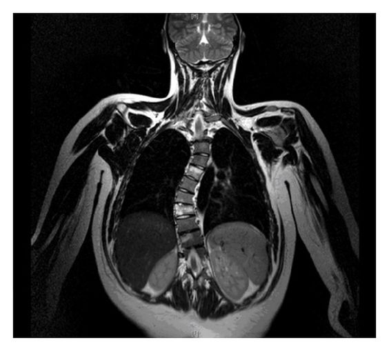 МРТ грудного отдела позвоночника - показания, как делают